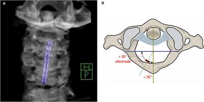 Related Factors and Outcome of Spinal Cord Stimulation Electrode Deviation in Disorders of Consciousness